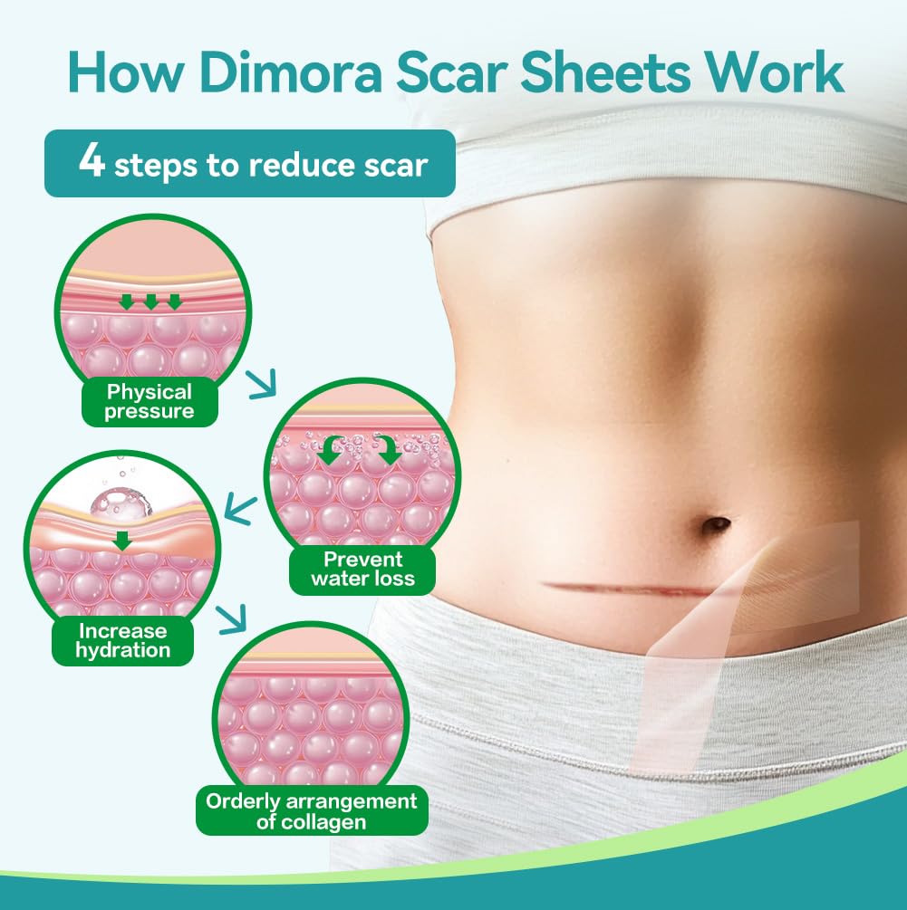 Dimora Medical Grade Silicone Scar Sheets — Ultra Soft Scar Tape (1.6x60 in), Hypoallergenic & Sensitive-Skin Safe
