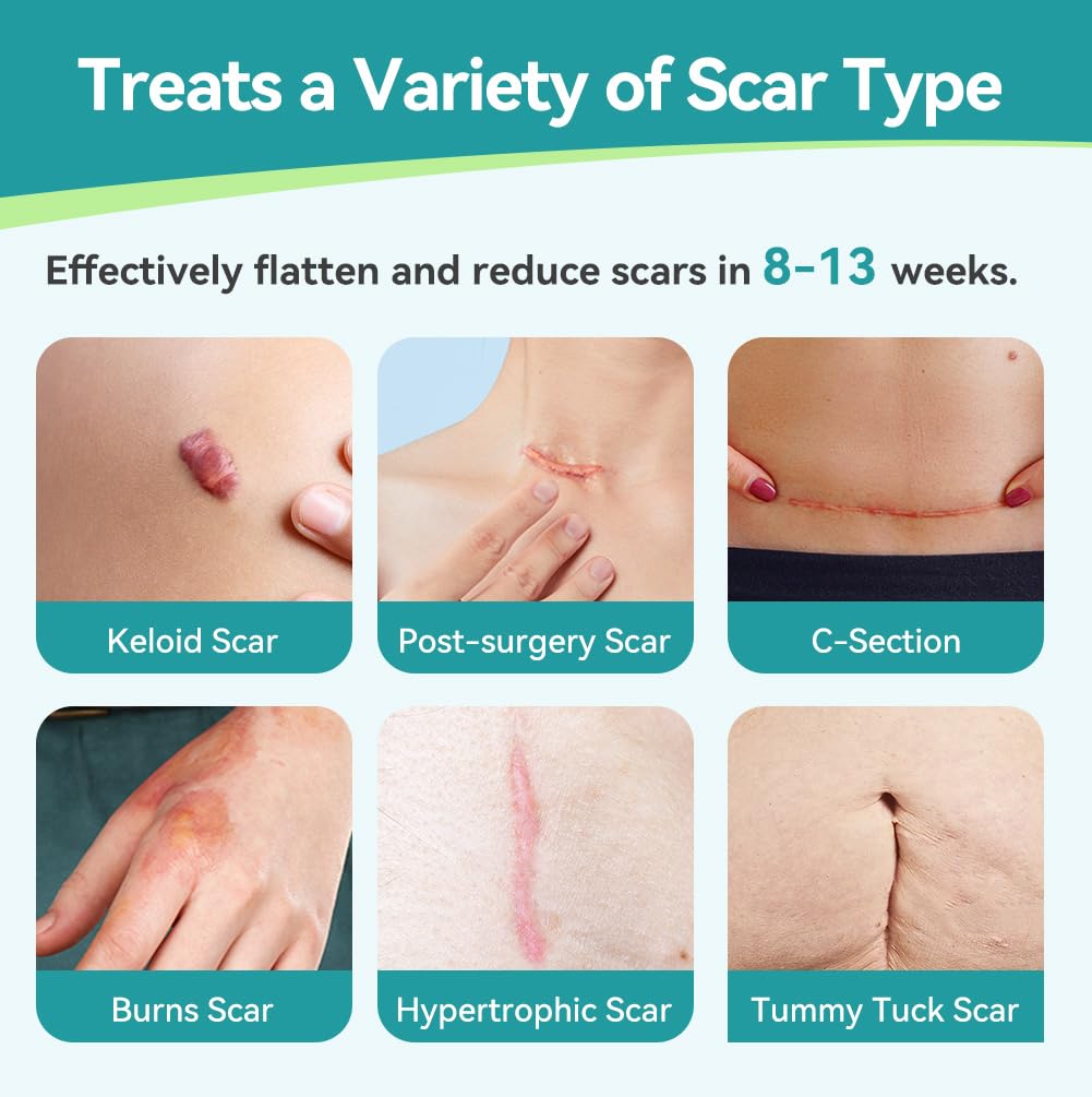 Dimora Medical Grade Silicone Scar Sheets — Ultra Soft Scar Tape (1.6x60 in), Hypoallergenic & Sensitive-Skin Safe