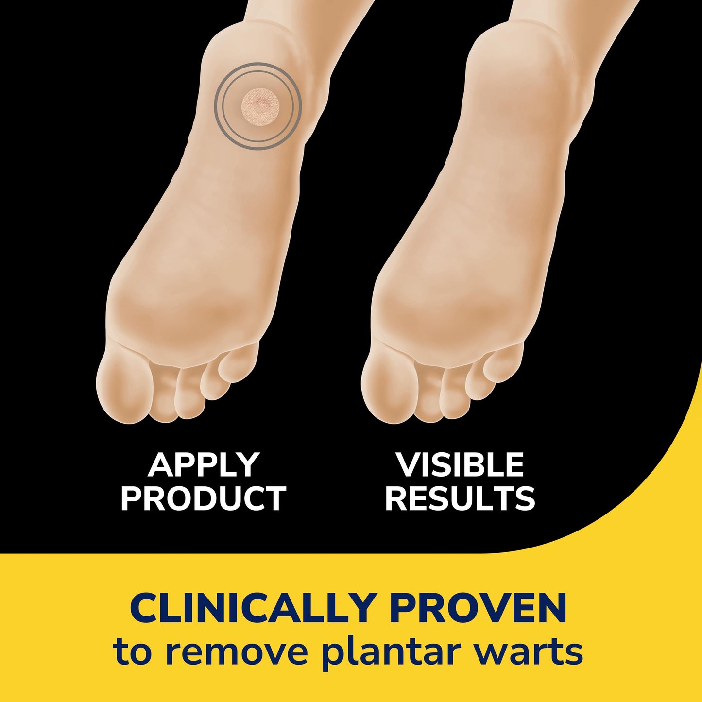 Dr Scholl's Clear Away Plantar Wart Remover - Extra-Thick Bandages for Feet, 24 Treatments