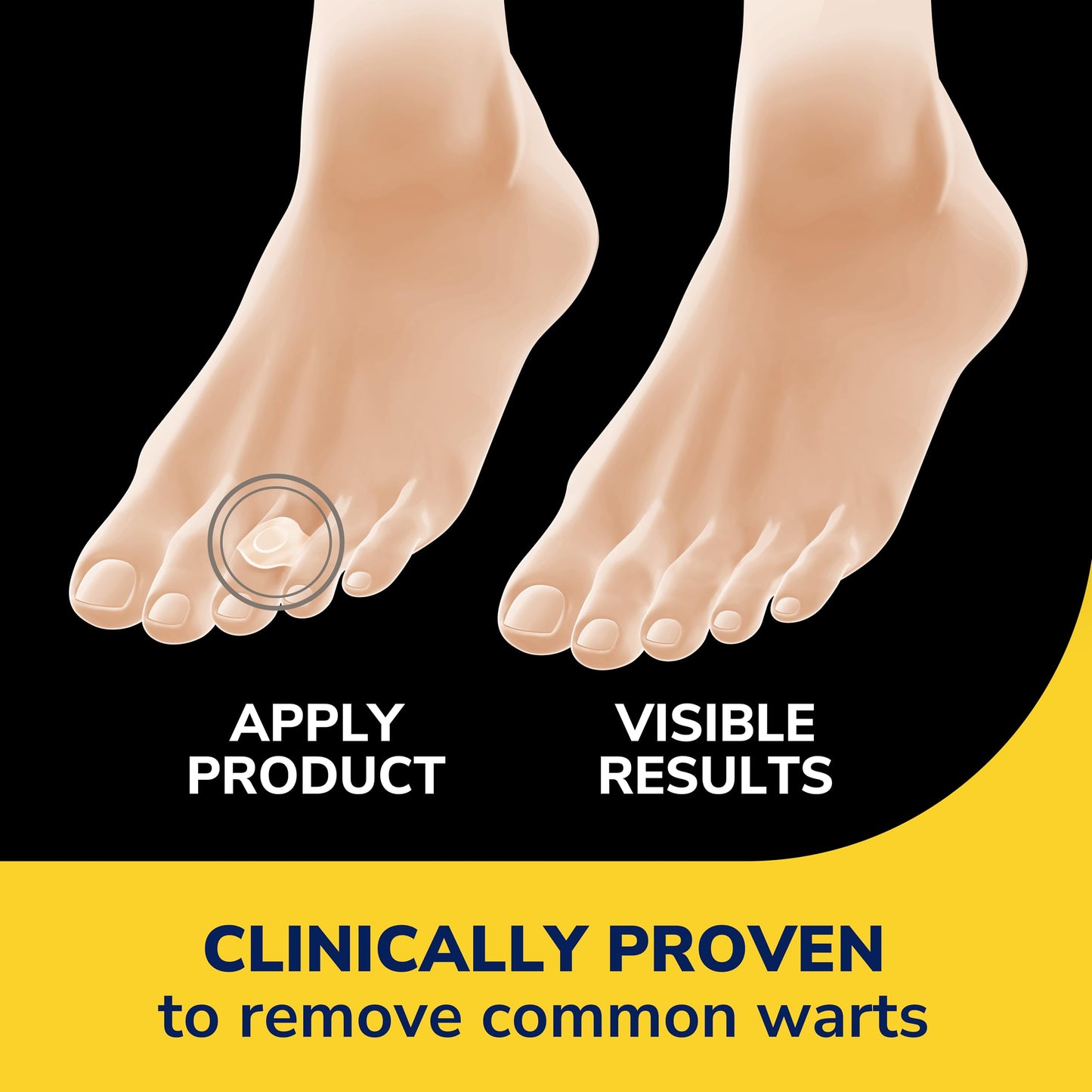 Dr. Scholl’s Clear Away Wart Remover Hydrogel Bandages for Fingers & Toes | Clinically Proven Wart Removal & Cushioning