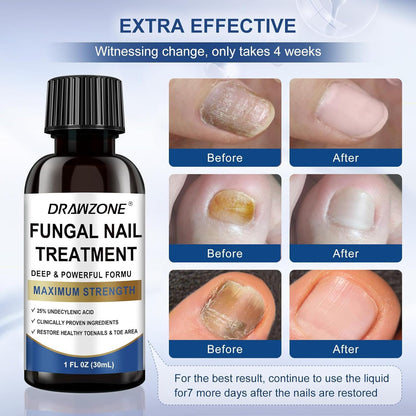 Drawzone Toenail Fungus Treatment Extra Strength – 25% Undecylenic Acid, Nail Renewal