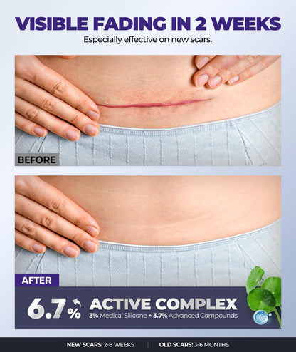 EASEWAVE Silicone Scar Cream – 6.7% Active, Visible in 2 Weeks (55ML)