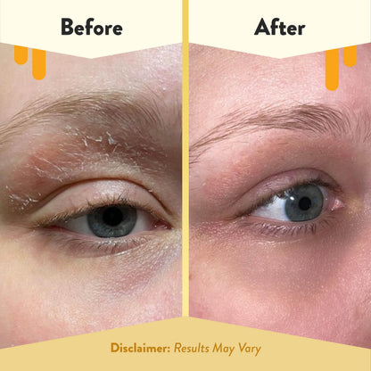 ECZEMA HONEY Multi Peptide Eye Cream — Anti-Aging Eye Care for Dark Circles & Puffiness (0.5 oz)