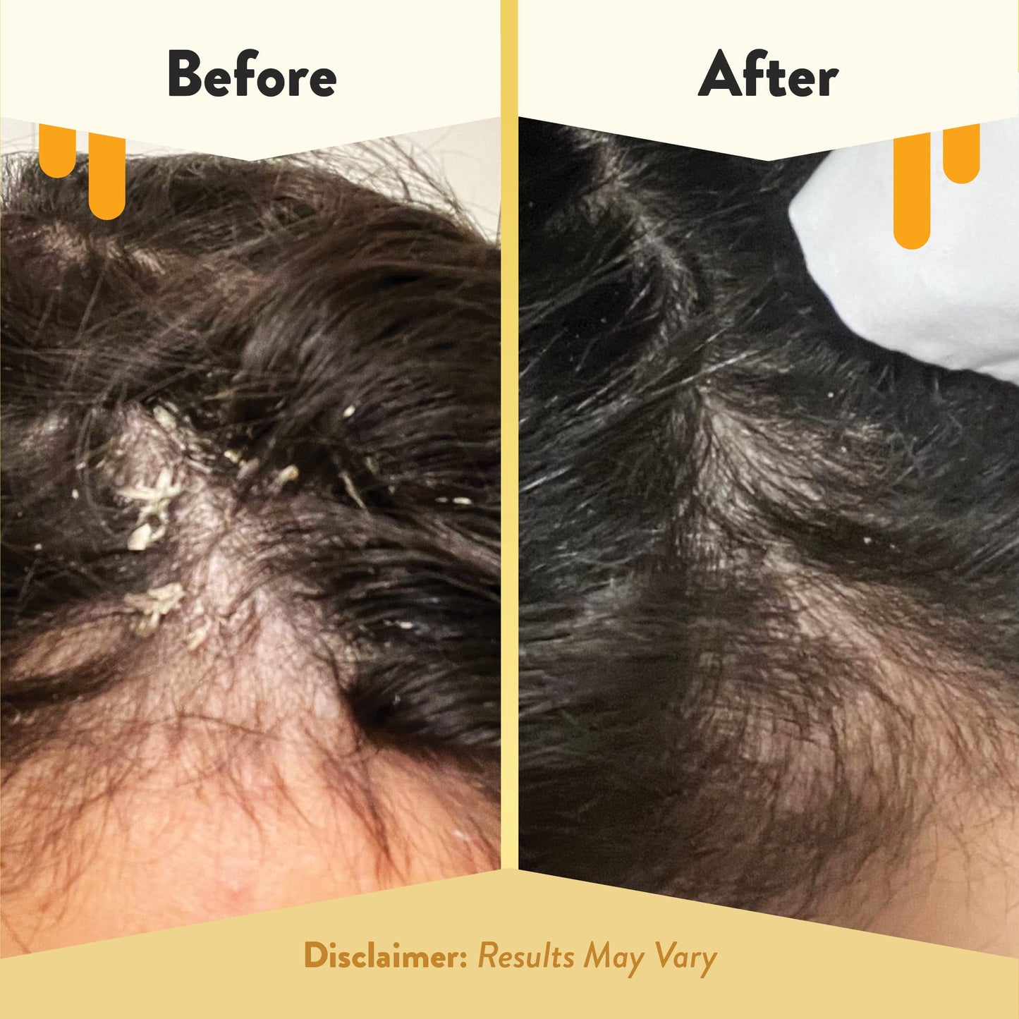 ECZEMA HONEY Soothing Scalp Oil – Natural Honey Hair Care for Itchy, Dry Scalp