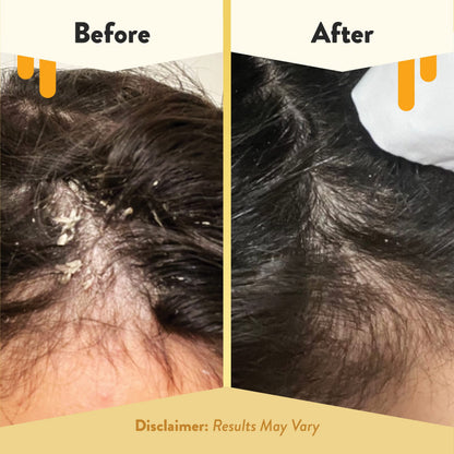 ECZEMA HONEY Soothing Scalp Oil – Natural Honey Hair Care for Itchy, Dry Scalp