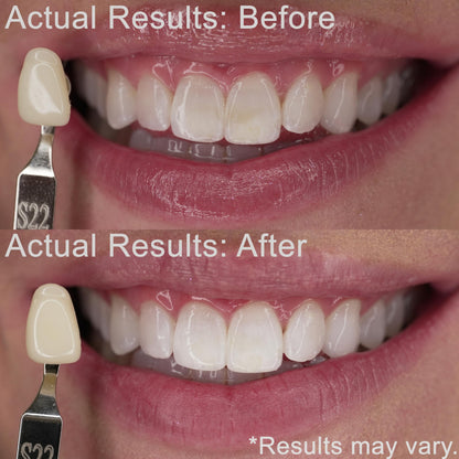 EZZI Teeth Whitening Kit - Fast 44% Carbamide Peroxide Whitening for Discolored Teeth and Intrinsic Stains