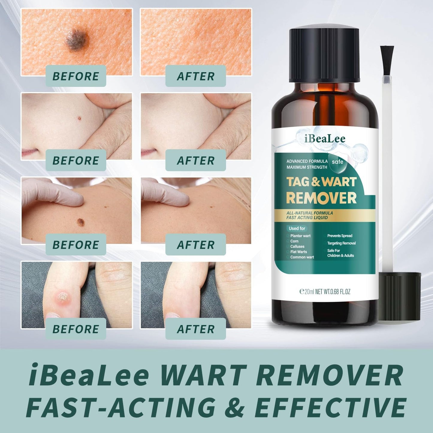 ELEFOCUS Wart Remover Liquid 12% Salicylic Acid – Fast Acting Wart Treatment 20ml