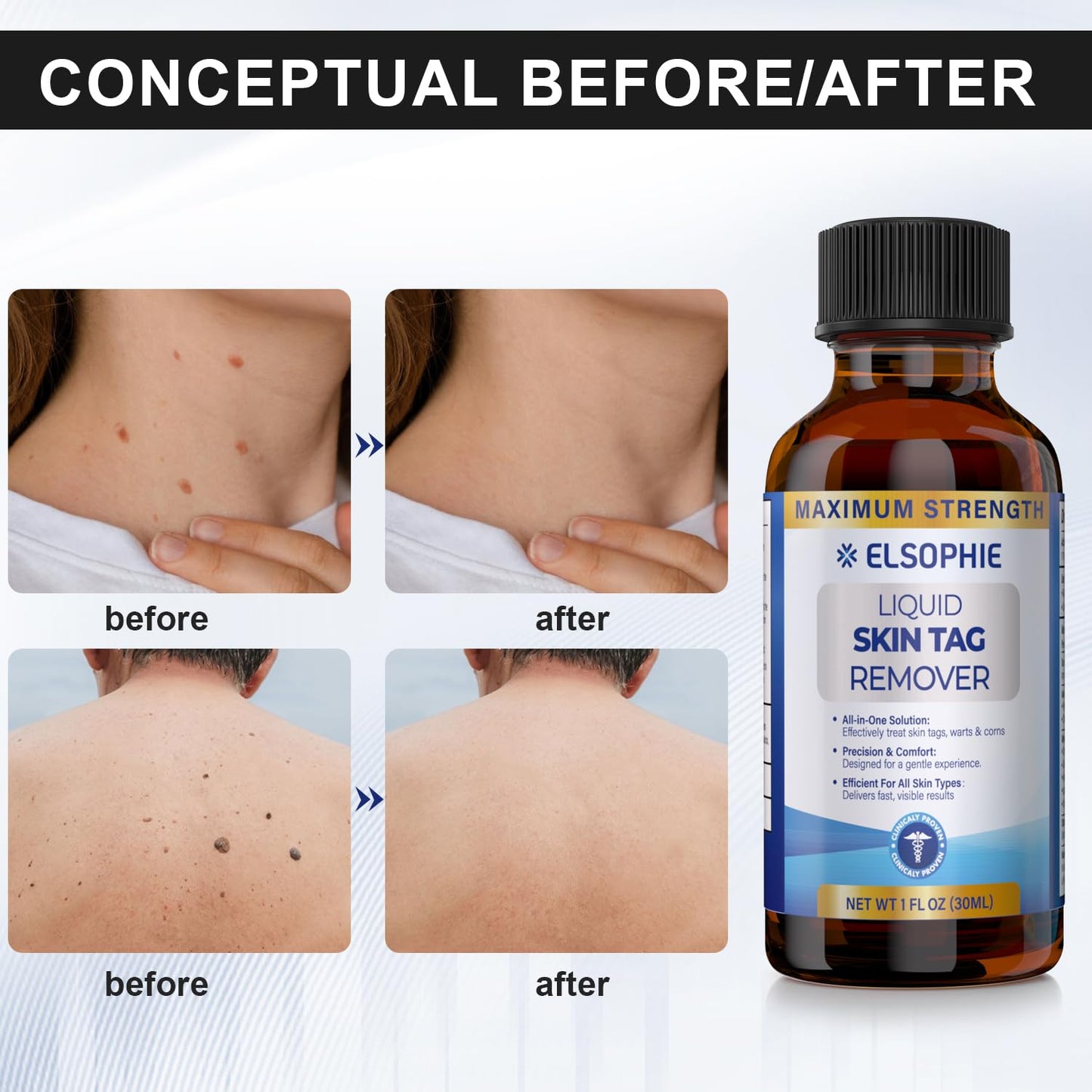 Elsophie Fast-Acting Skin Tag Removal Freeze Away – Maximum Strength Salicylic, All-in-One 30 ml