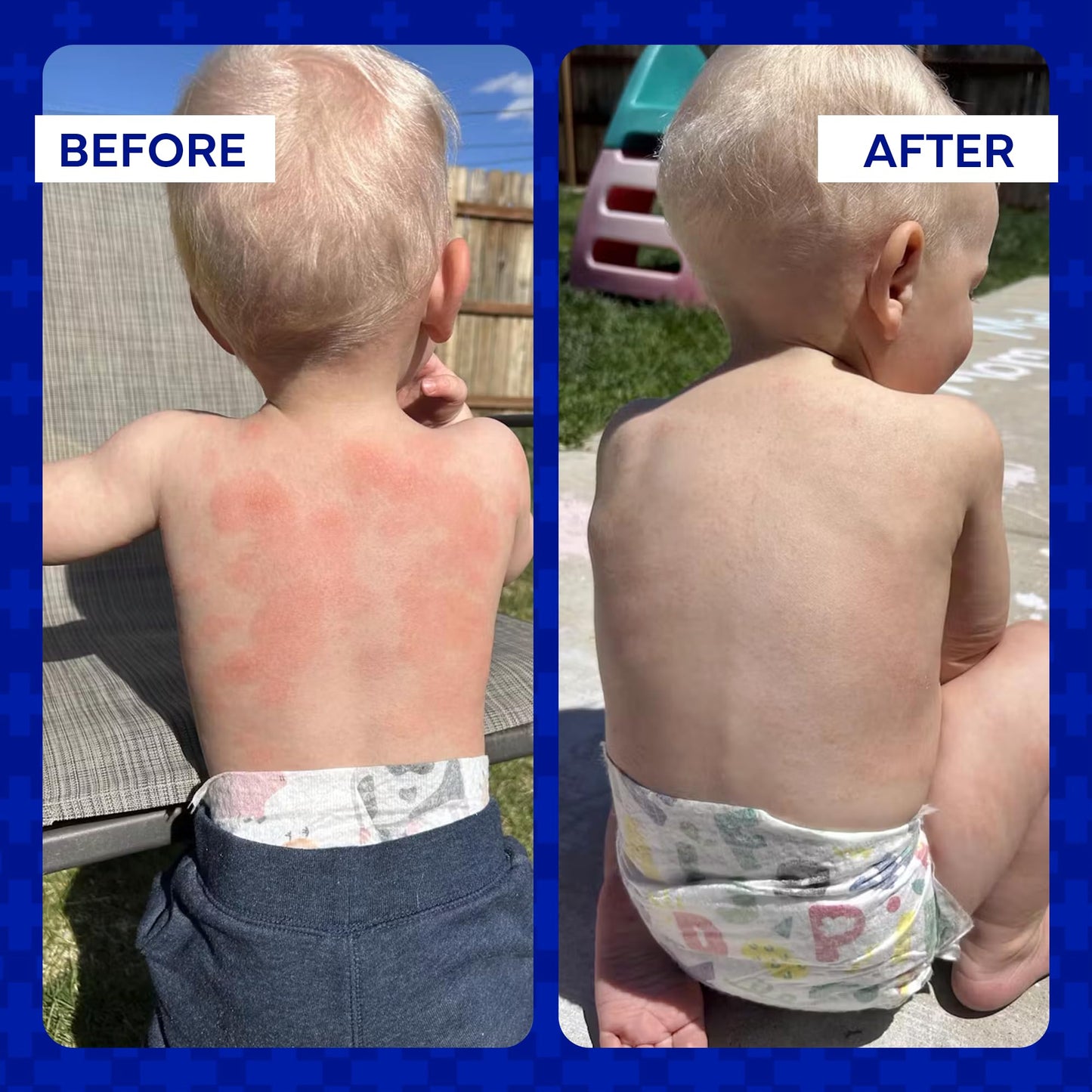 EMUAID Ointment for Eczema & Psoriasis Relief | Steroid-Free, All Ages, 2oz