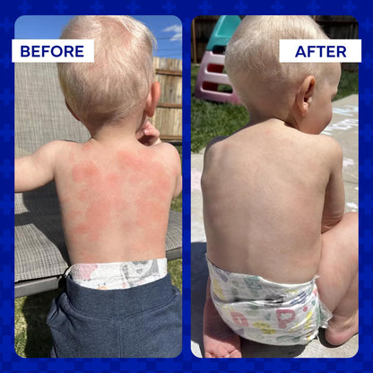 EMUAID Ointment for Eczema & Psoriasis Relief | Steroid-Free, All Ages, 2oz