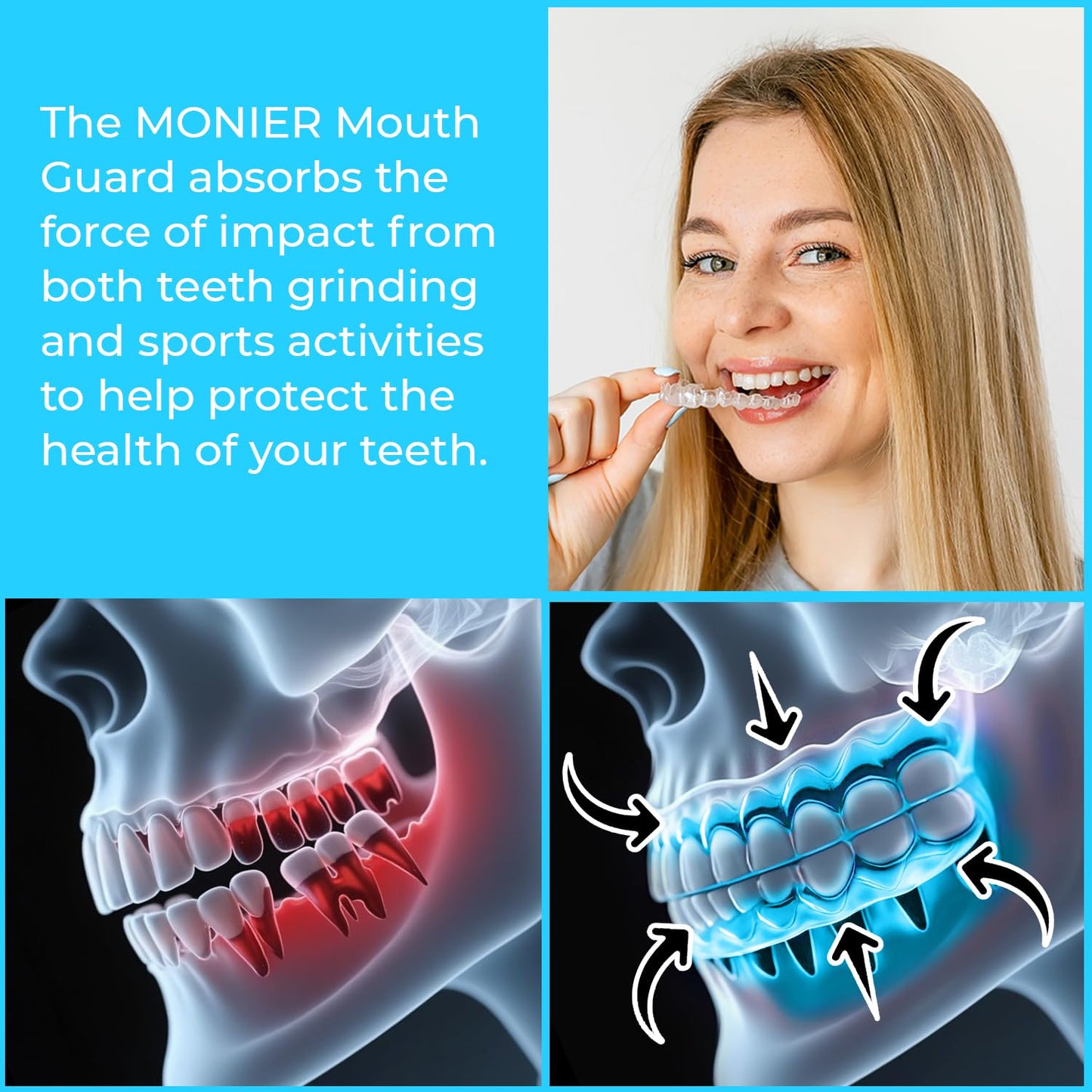 Mouth Guard for Teeth Grinding at Night | MONIER Night Guard