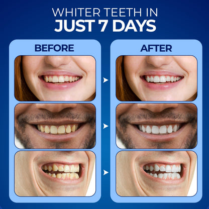Euphauria Home Teeth Whitening Kit with LED Light - 3 Gel Pens, No Sensitivity