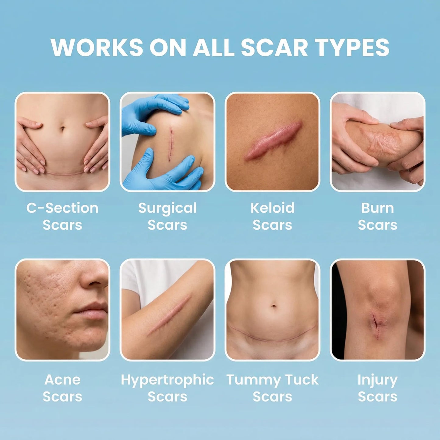 Eva Naturals Medical Grade Silicone Scar Tape 1.6in x 120in – Reusable Sheets for Surgical, C-Section, Keloid & Burn Scars