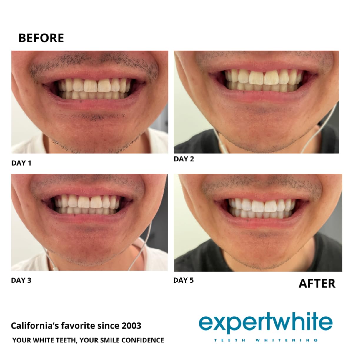 Expertwhite 22% Carbamide Peroxide Teeth Whitening Gel Refills – Made in USA