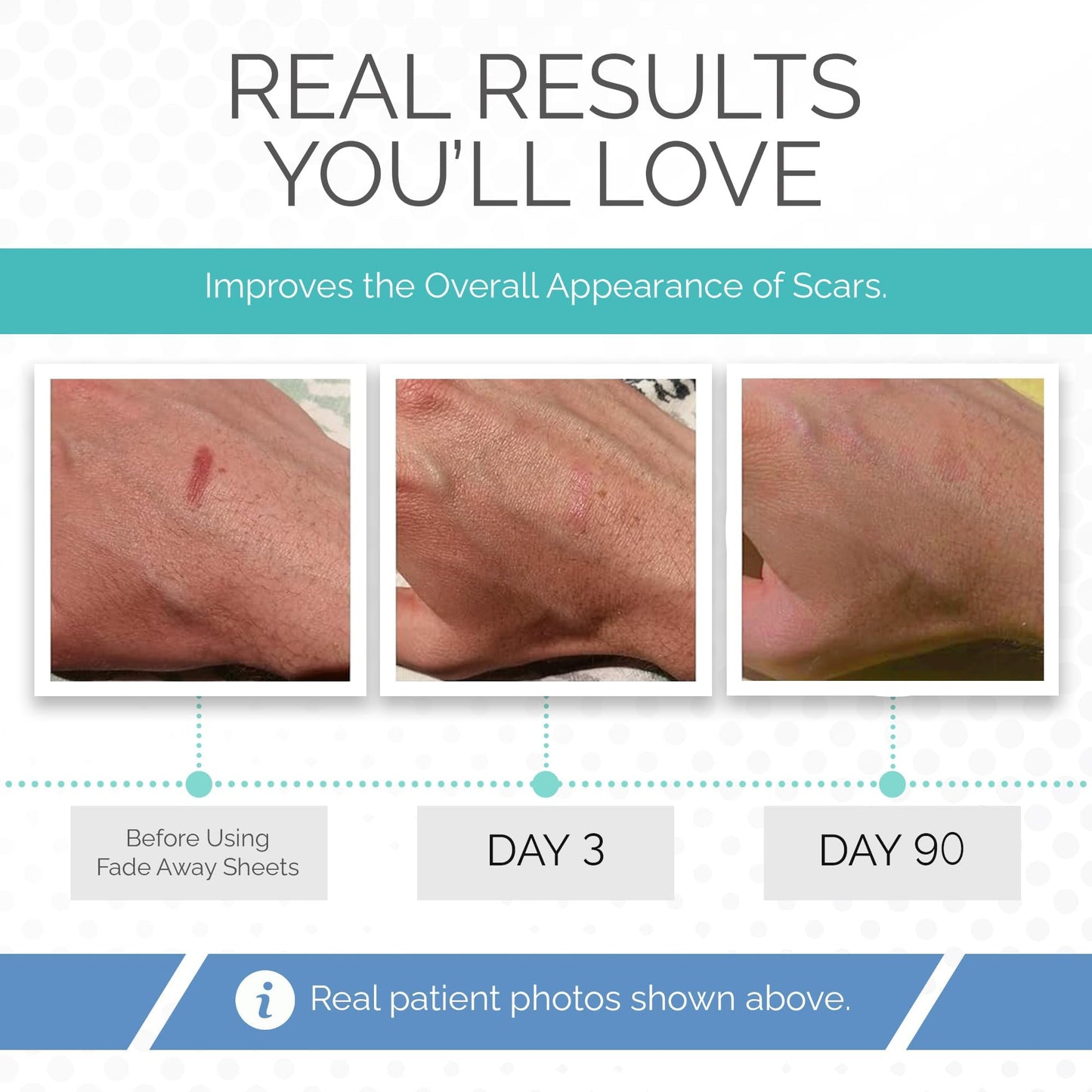 Fade Away Clinically Proven Silicone Scar Sheets – Medical Grade Tape for Surgery, C-Section, Keloids & Tummy Tuck Scars