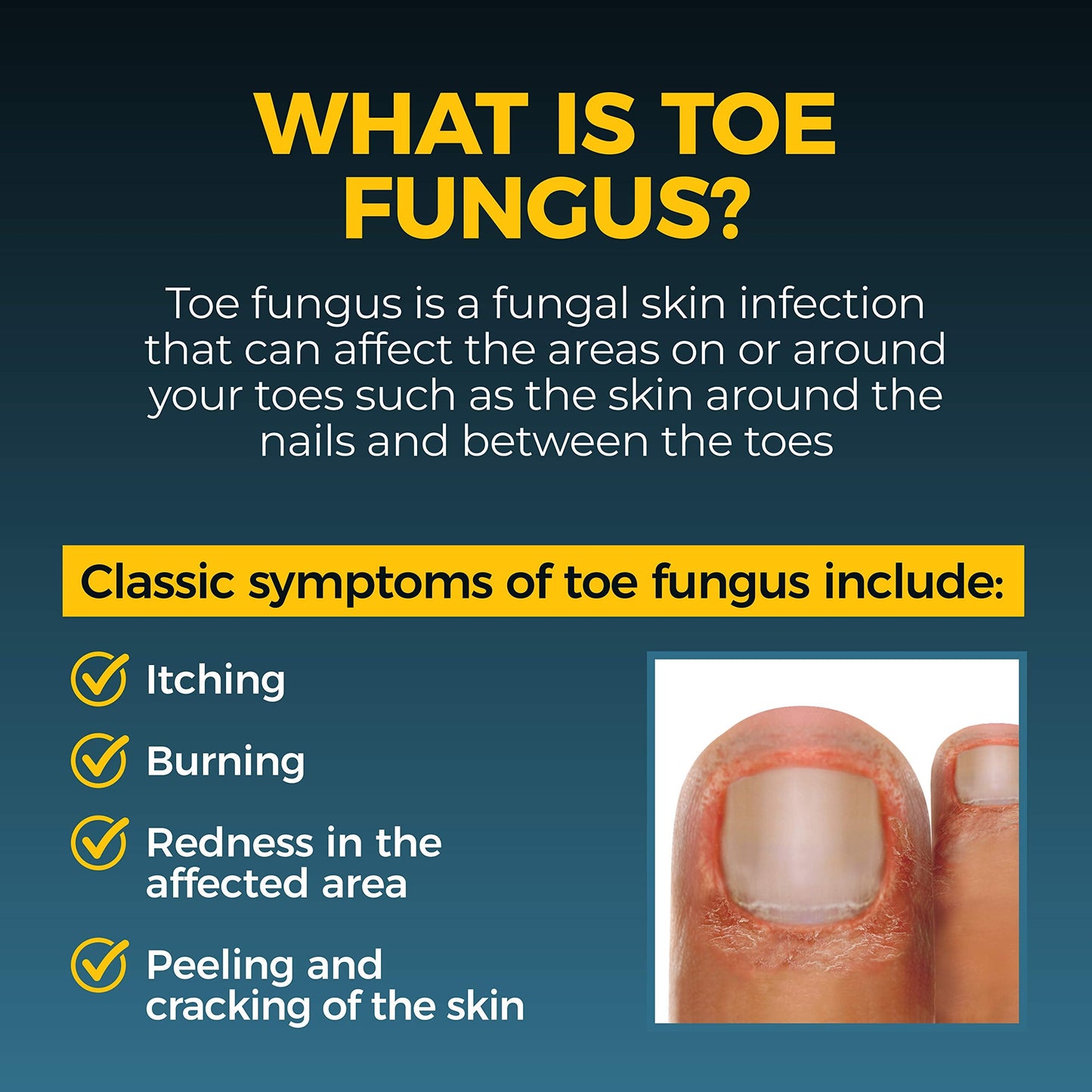Fungi-Nail Pen Applicator Anti-Fungal Solution | Tolnaftate 1% - Targeted Nail & Foot Fungus Care