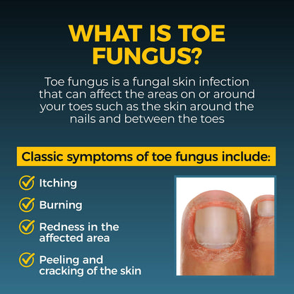 Fungi-Nail Pen Applicator Anti-Fungal Solution | Tolnaftate 1% - Targeted Nail & Foot Fungus Care