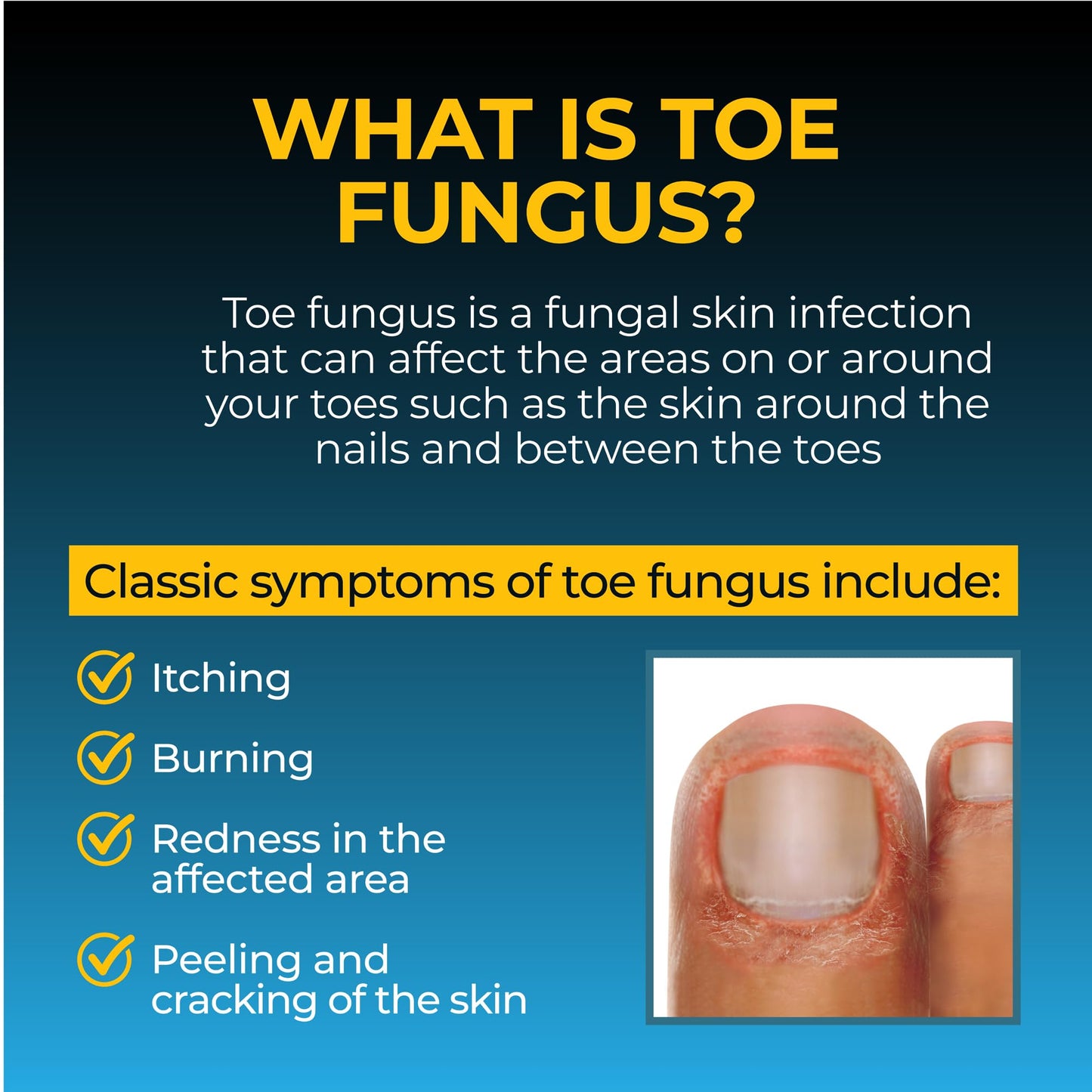 Fungi-Nail Pen Applicator Anti-Fungal Solution | Tolnaftate 1% - Targeted Nail & Foot Fungus Care