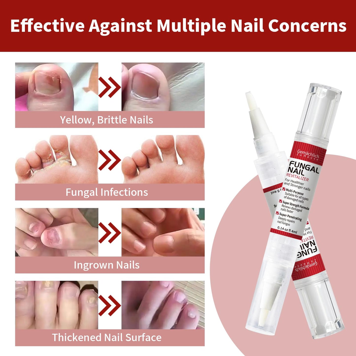 Gemächlich ZuHause Toenail Fungus Treatment Extra Strength Pen – 3 Pens & 3 Files