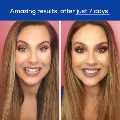 GLO Science Teeth Whitening Gel – 6% Hydrogen Peroxide, 10 Gel Vials + Lip Care