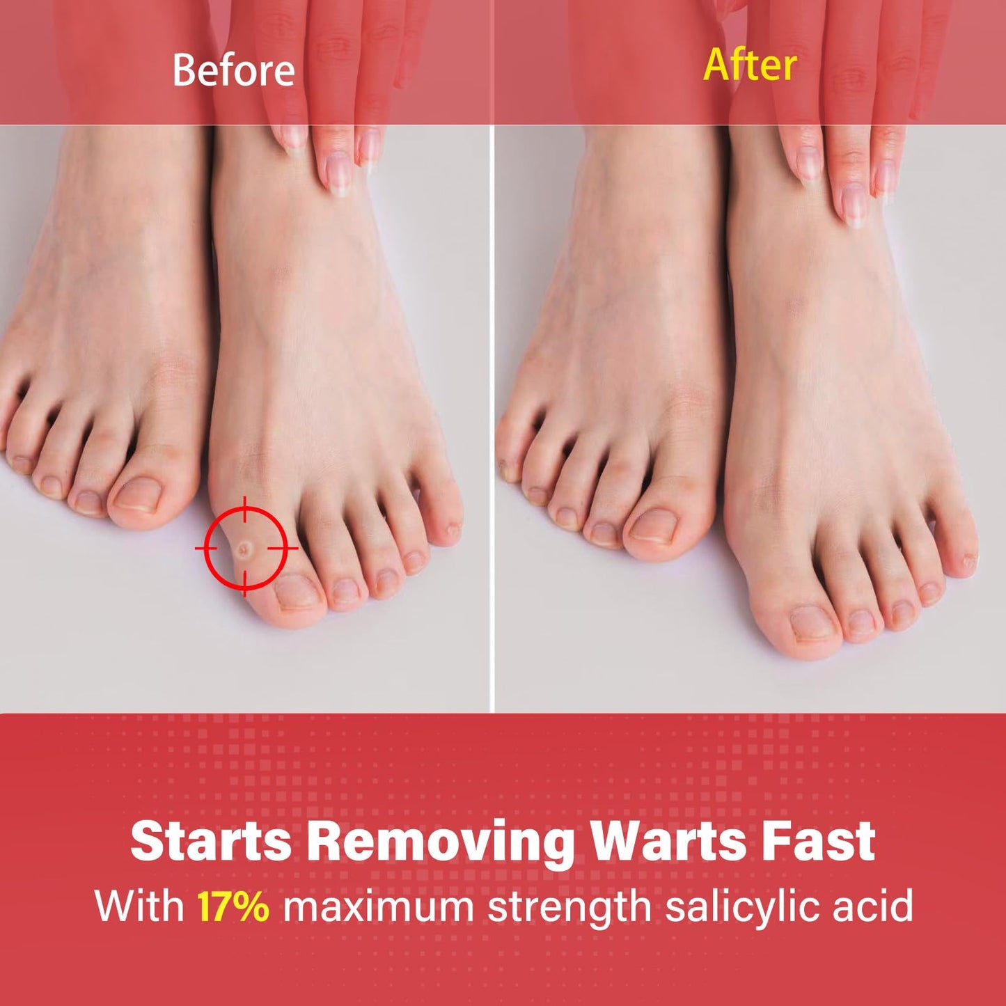 Goodnites Fast-Acting Wart Remover | 17% Salicylic Acid, Family Safe