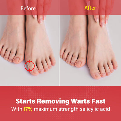 Goodnites Fast-Acting Wart Remover | 17% Salicylic Acid, Family Safe