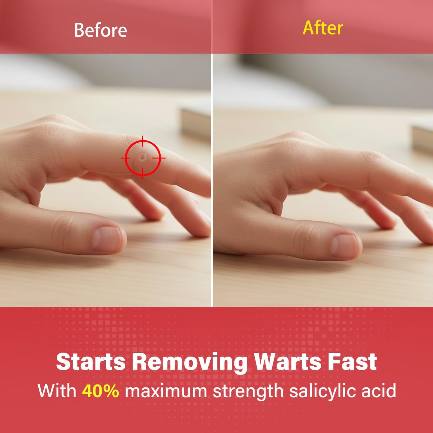 Goodnites Wart Remover Pads – Maximum Strength 40% Salicylic Acid, 24-Count, 6 mm & 10 mm Patches for Common & Plantar Warts