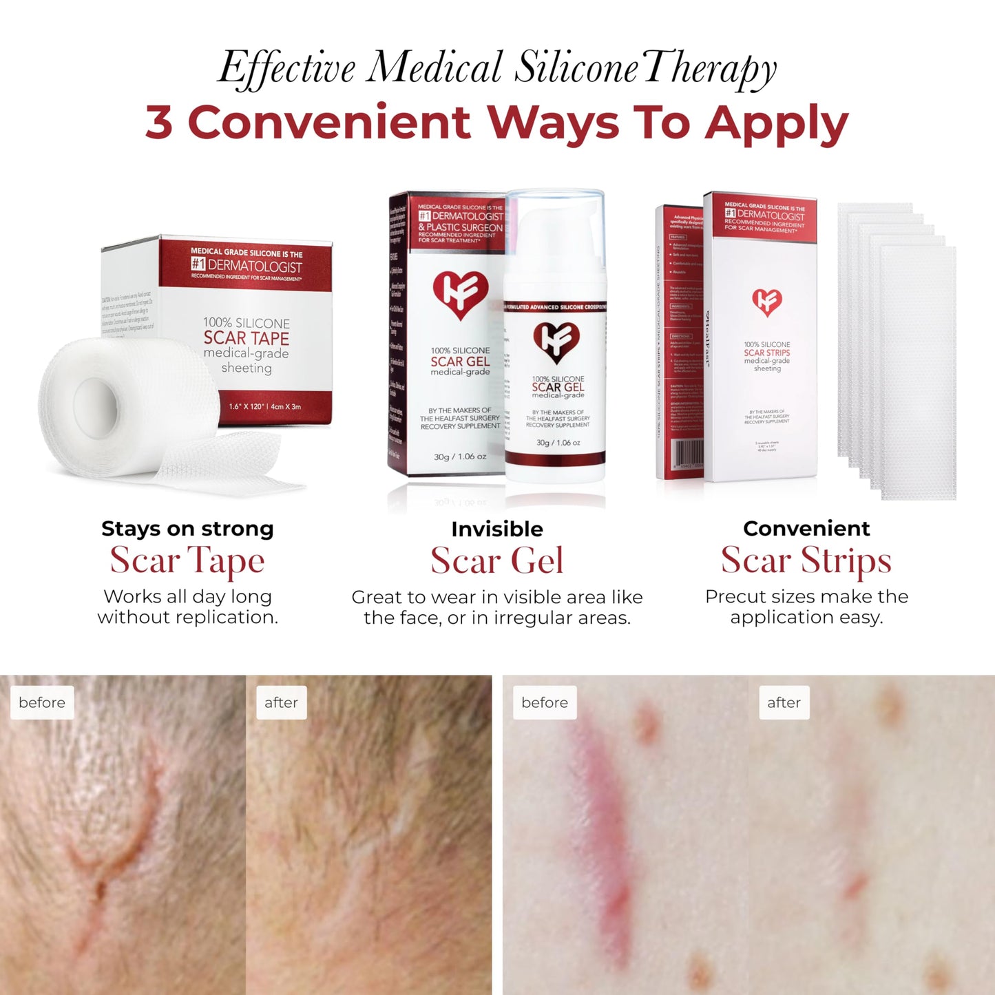 HealFast Physician Formulated Silicone Scar Sheets – Medical-Grade Tape for Surgery, C-Section & Keloids