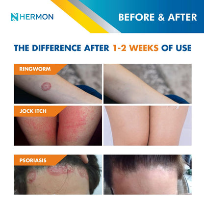 Hermon Powerful Antifungal Ringworm Cream - Fast Relief for Ringworm, Jock Itch & More (100ml)
