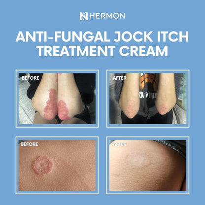 Hermon Jock Itch Antifungal Cream - 2 Pack | Ringworm, Psoriasis & Skin Comfort