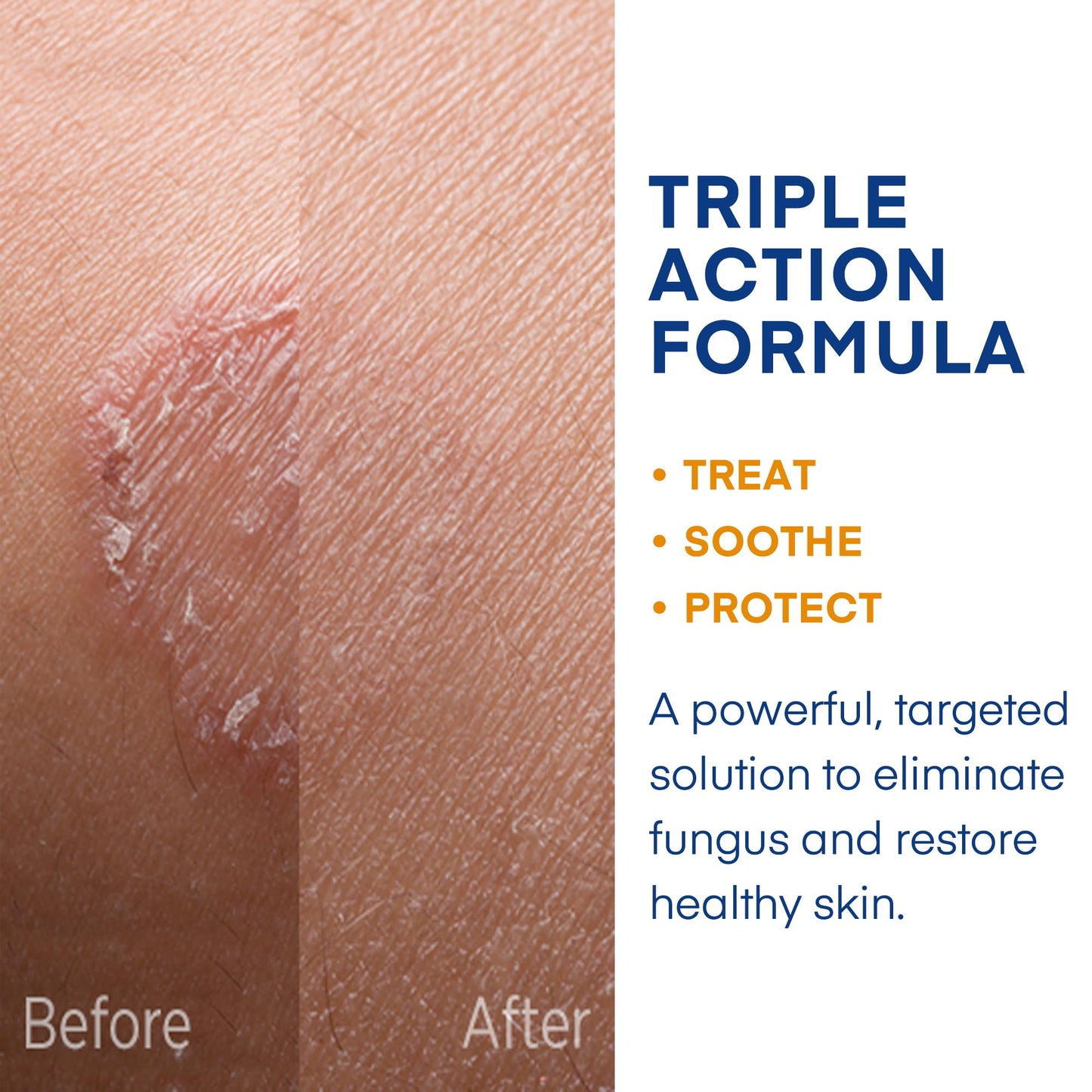 Hermon Powerful Antifungal Ringworm Cream - Fast Relief for Ringworm, Jock Itch & More (100ml)