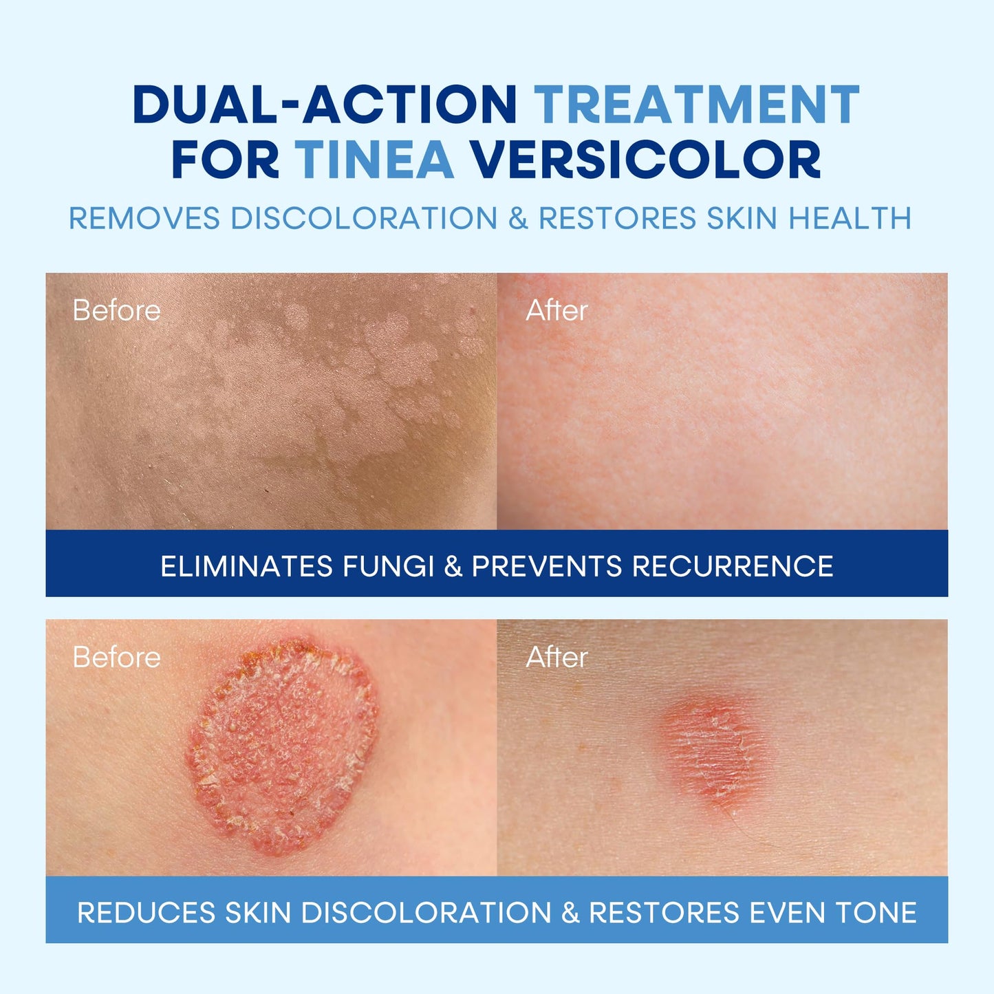 Hermon Tinea Versicolor Treatment Kit – Fast-Acting Cream 2oz & Soap 4oz