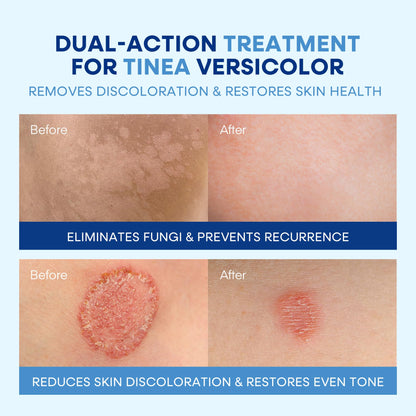 Hermon Tinea Versicolor Treatment Kit – Fast-Acting Cream 2oz & Soap 4oz