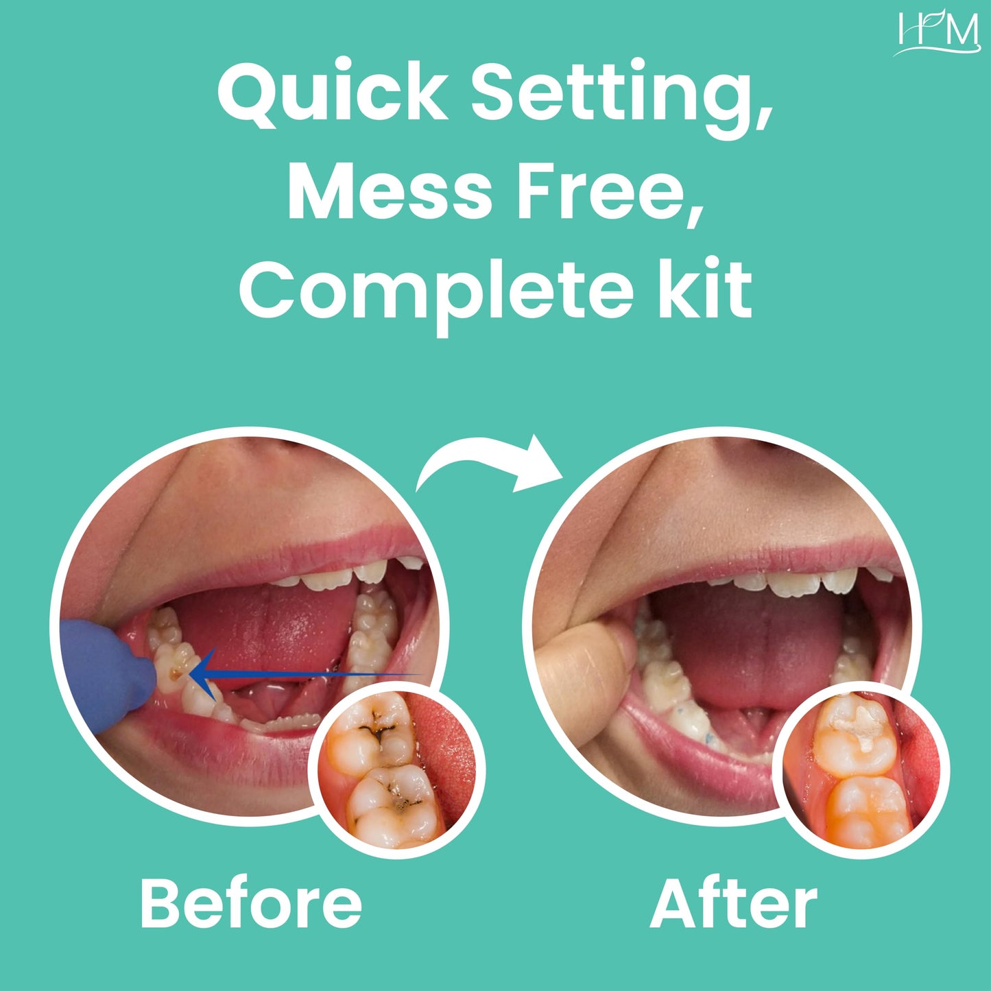 HM Zinc Oxide Eugenol Dental Cement Kit | DIY Self-Curing Tooth Repair & Emergency Care