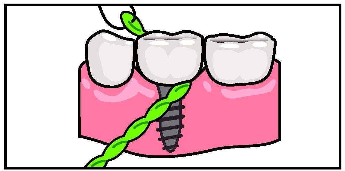 IDontix Brace X-Floss Green - Implants, Bridges & Braces