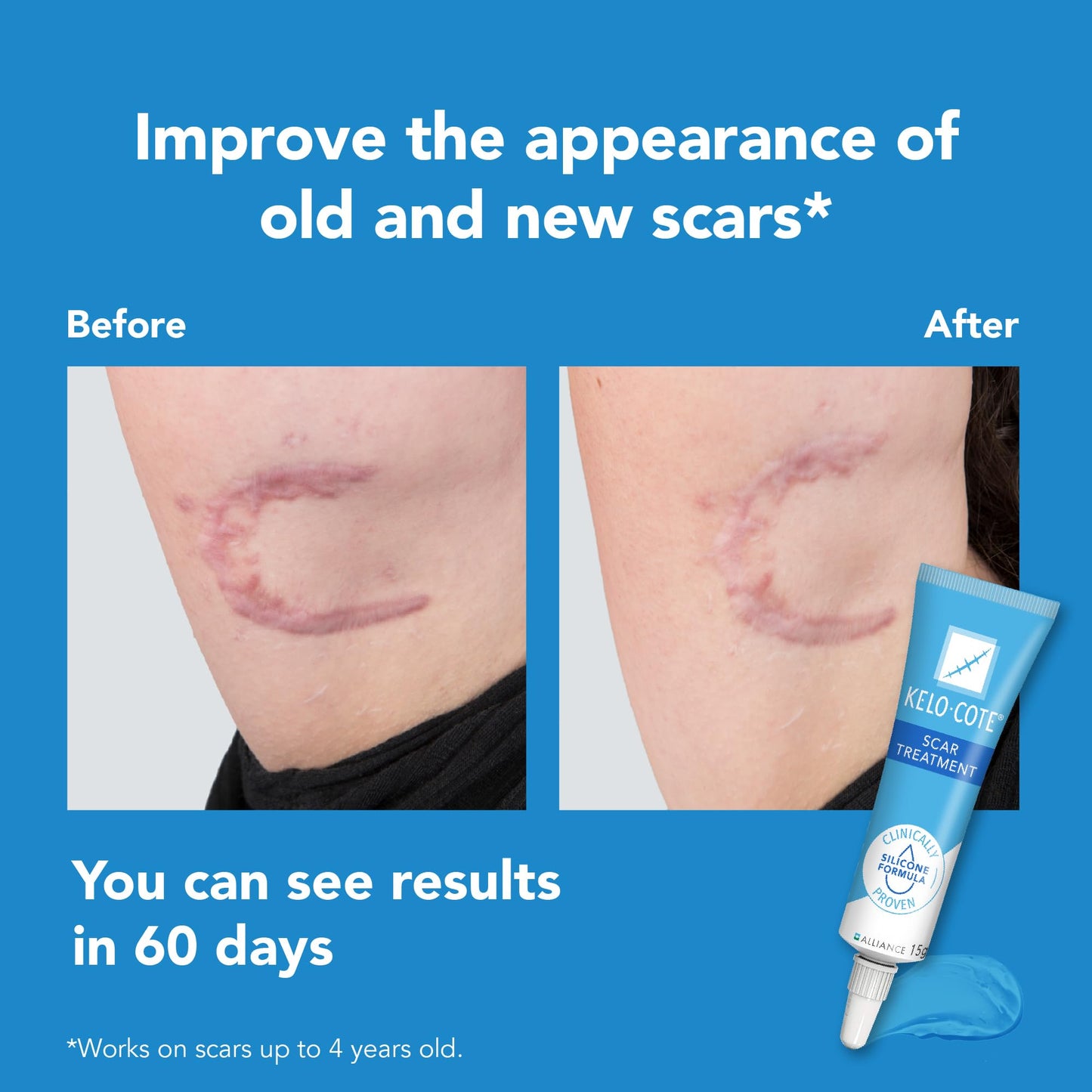 KELO-COTE Sinclair Kelo-Cote Gel for Scars 0.53 oz – Silicone Scar Treatment