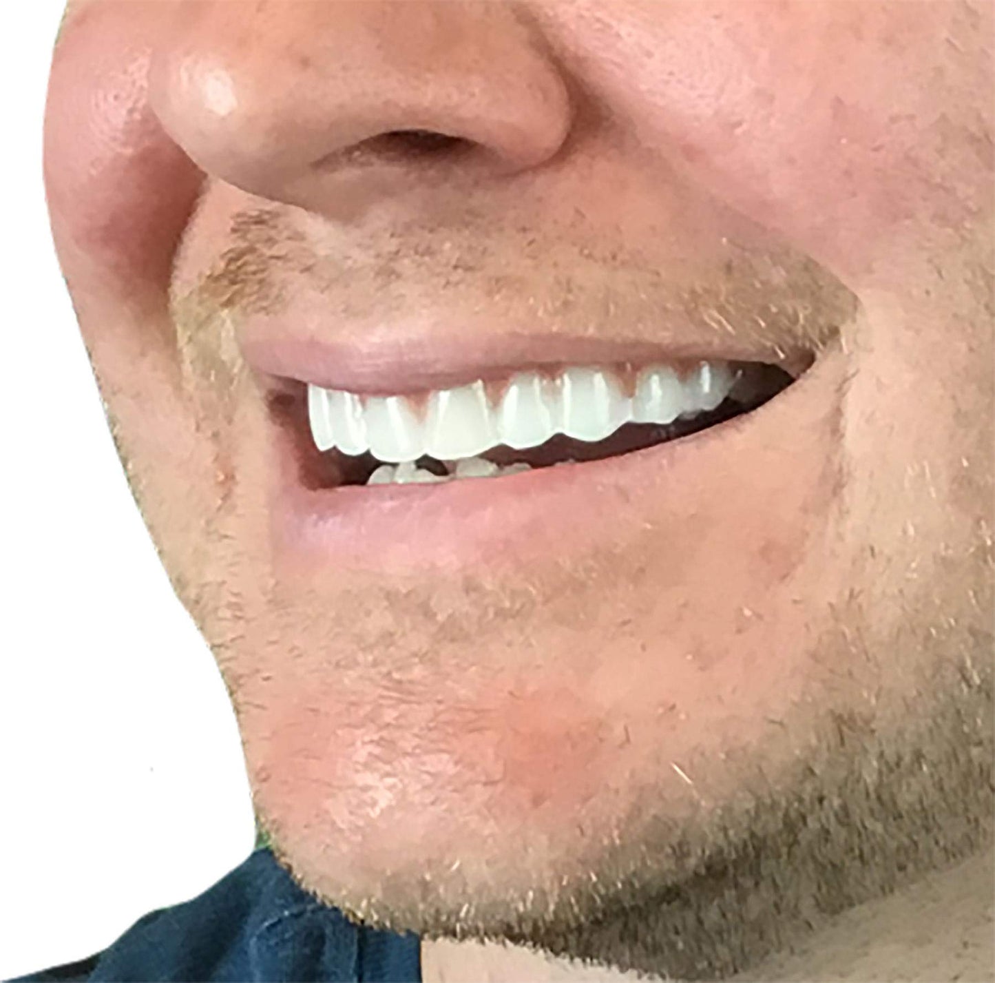 Instant Smile Comfort Fit Flex Upper Veneer - Bright Shade Cosmetic Teeth