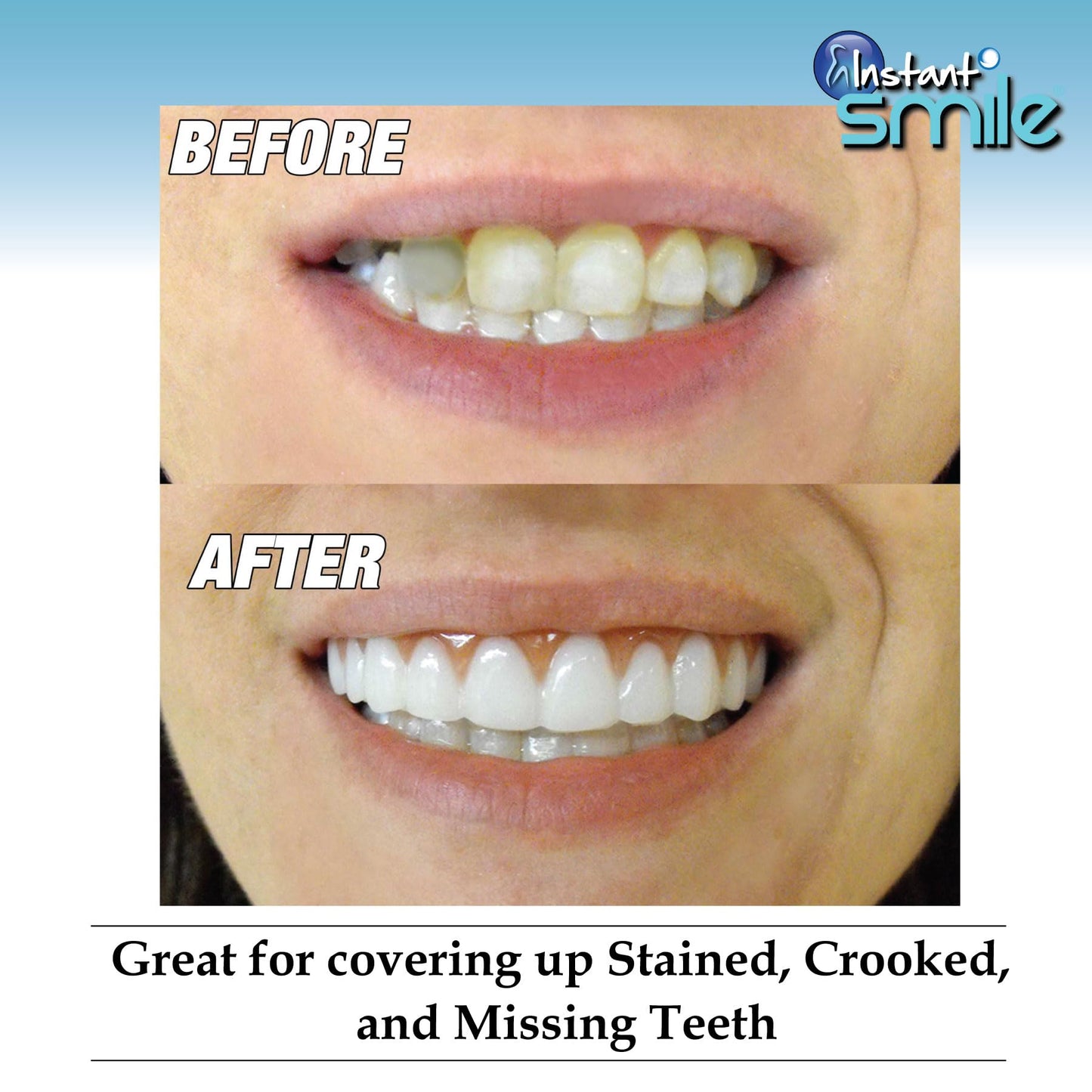 Instant Smile Comfort Fit Flex Upper Veneer - Bright Shade Cosmetic Teeth