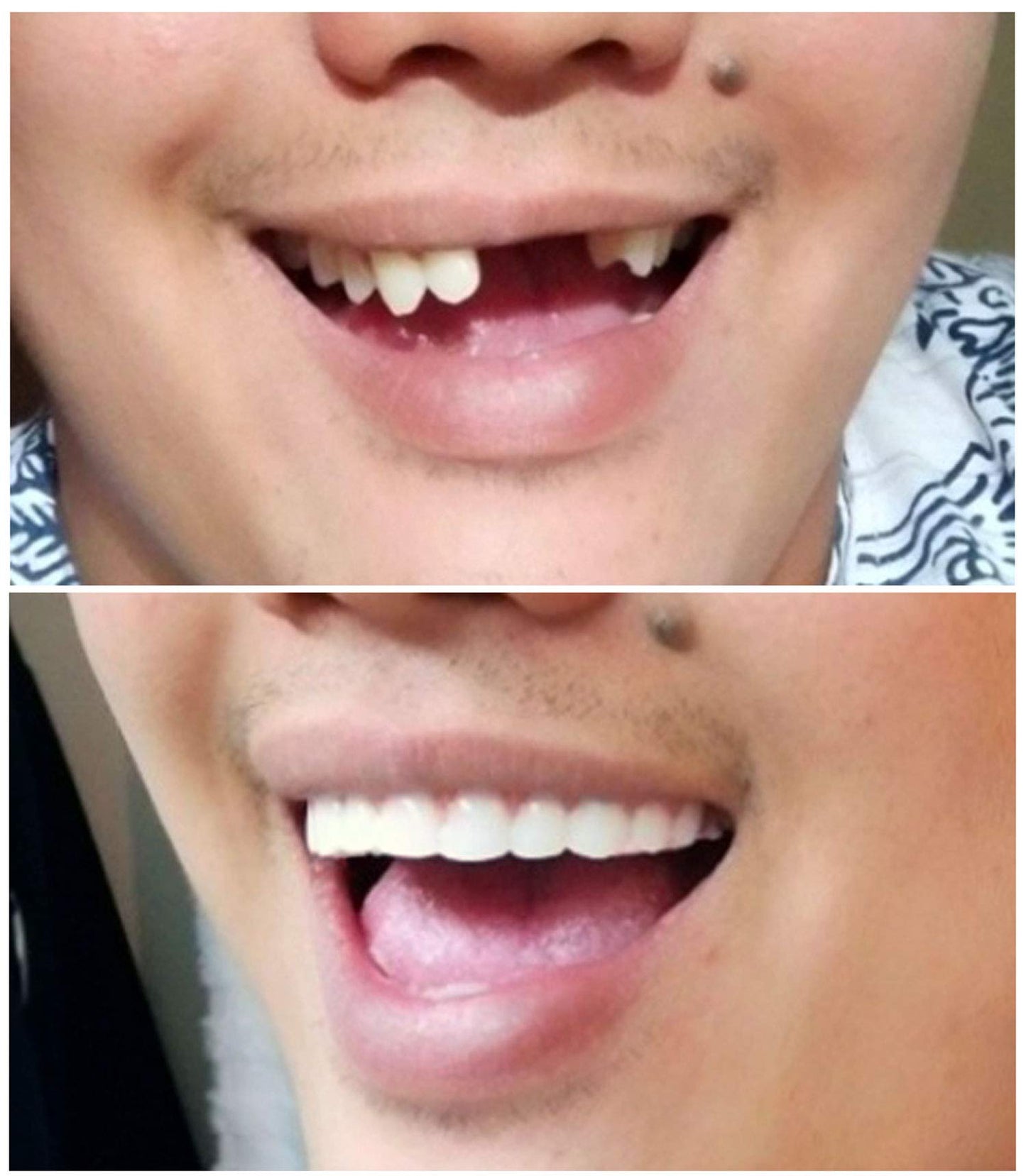 Instant Smile Comfort Fit Flex Upper Veneer - Bright Shade Cosmetic Teeth