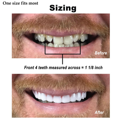 Instant Smile Comfort Fit Flex Upper Veneer - Bright Shade Cosmetic Teeth