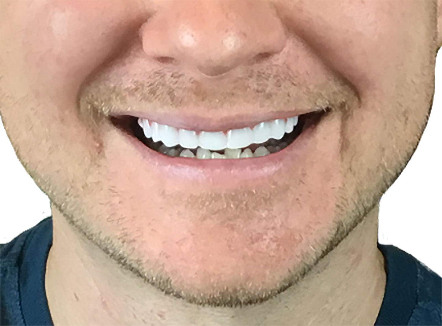 Instant Smile Flex 2pk - Bright White Upper Veneer | One Size