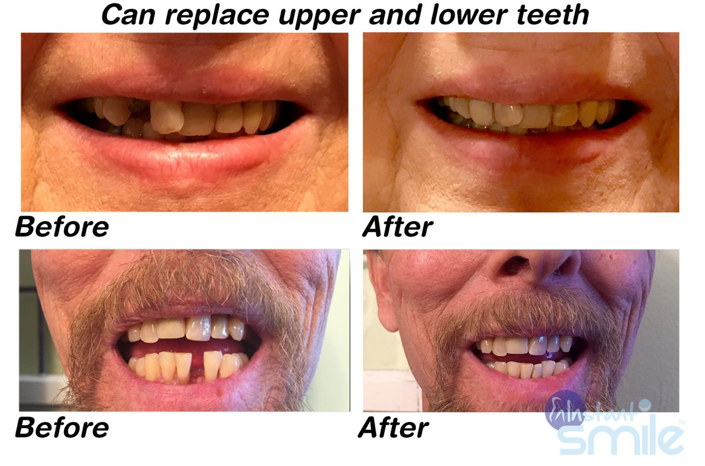 Instant Smile MULTISHADE Patented Temporary Tooth Repair Kit | Realistic Missing or Broken Tooth Solution