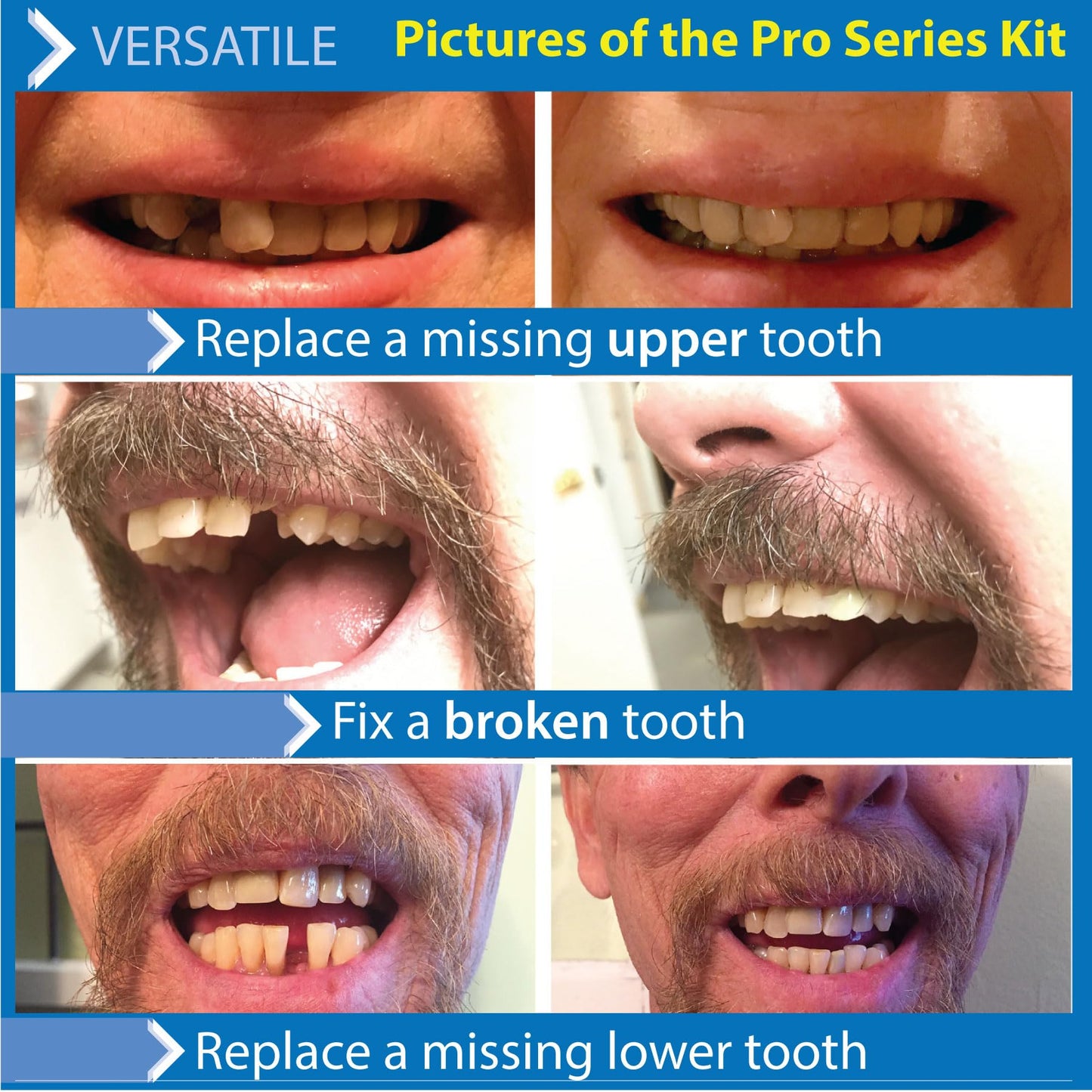 Instant Smile Pro Series Temporary Tooth Kit – At-Home Replacement
