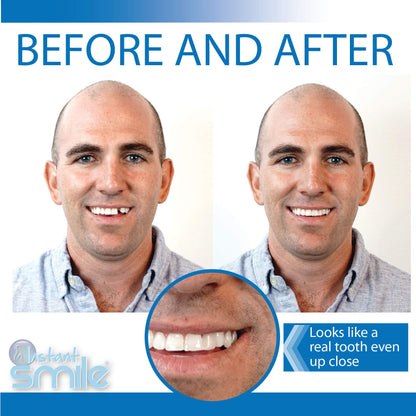 Instant Smile Temporary Tooth Kit -Pro-Series | Realistic, Customizable Tooth Replacement