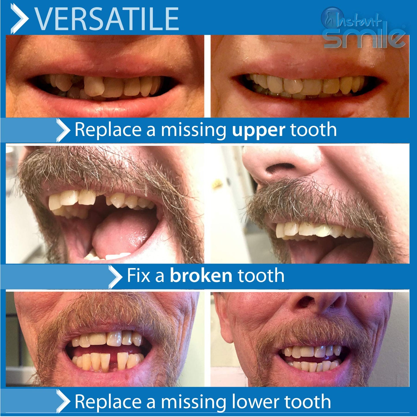 Instant Smile Temporary Tooth Kit -Pro-Series | Realistic, Customizable Tooth Replacement