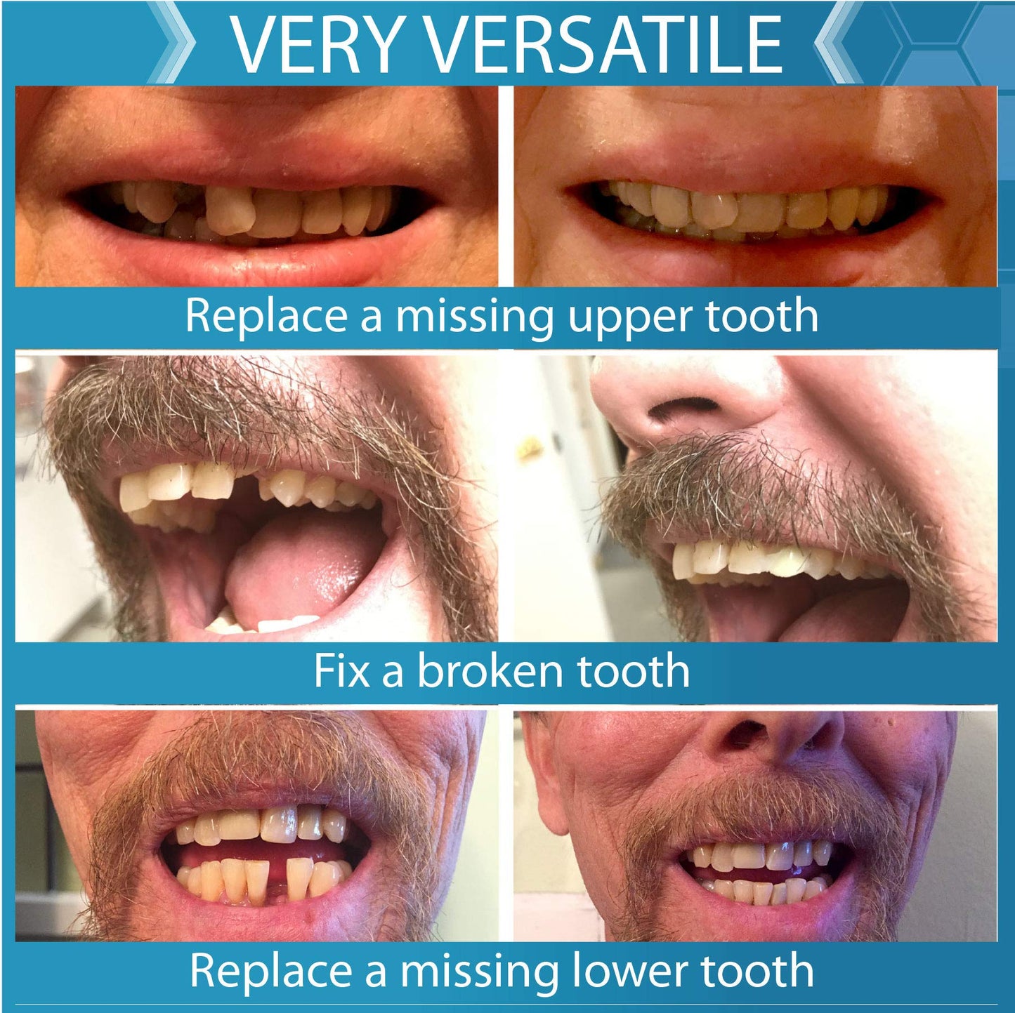 Instant Smile Temporary Tooth Replacement Kit - Replace a Missing Tooth Fast (Patented)