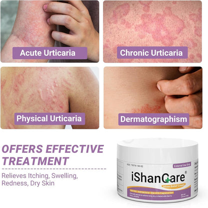 ishancare Urticaria Cream — Fast Acting Relief for Hives & Itchy Skin (3.53 oz)