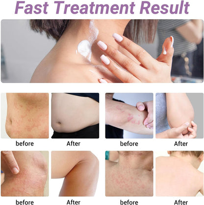 ishancare Urticaria Cream — Fast Acting Relief for Hives & Itchy Skin (3.53 oz)