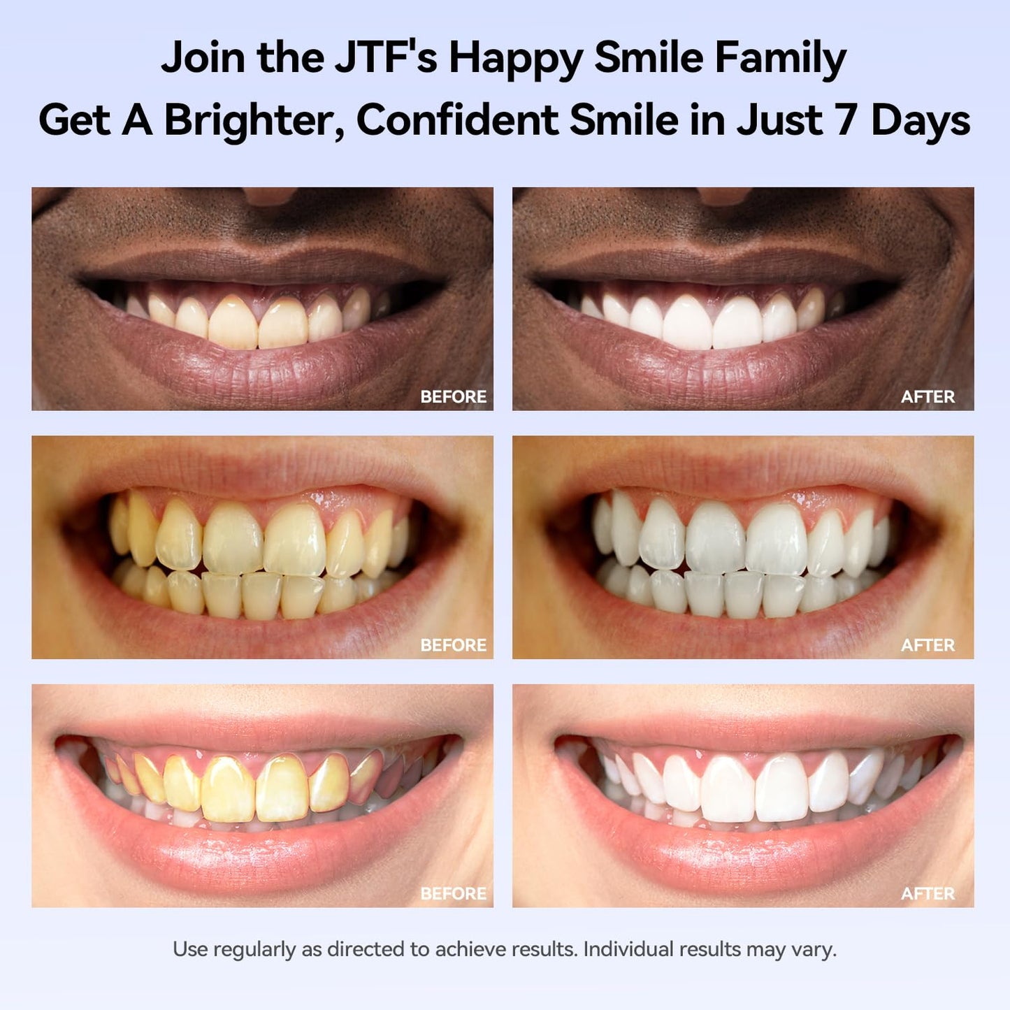 JTF Teeth Whitening Gel Kit – 35% Carbamide Peroxide, 5 Gels + Remineralization (Mint)