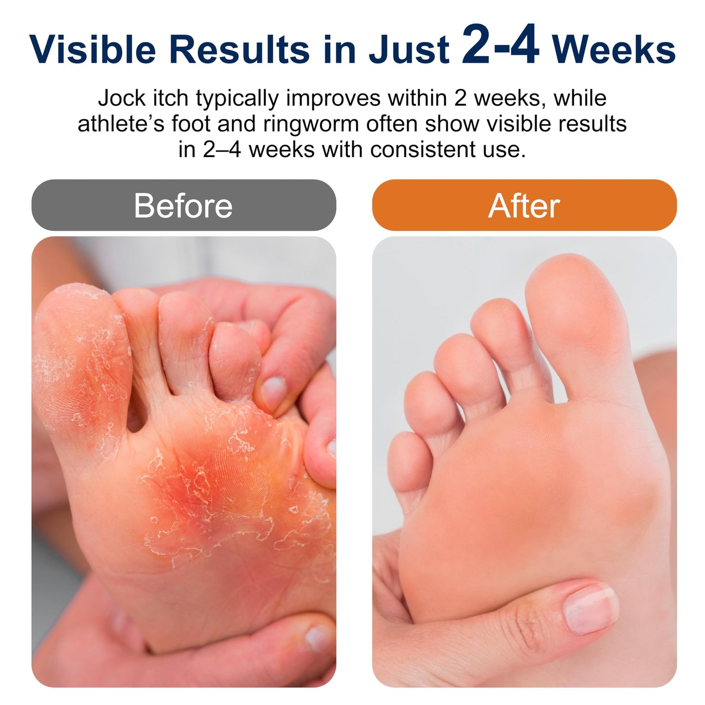 Kerova Antifungal Cream 2% Miconazole for Jock Itch, Athlete’s Foot & Ringworm – 3.5 oz